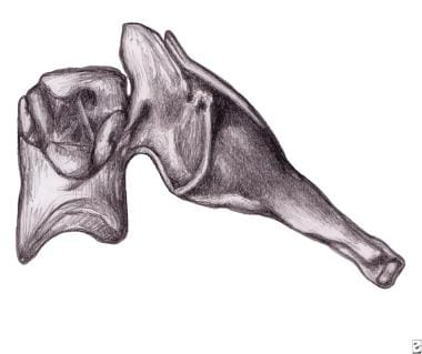 Cervical facet syndrome. 