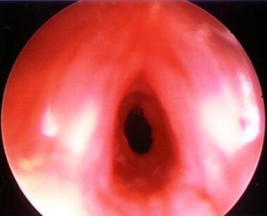 An intraoperative view of granular subglottic sten