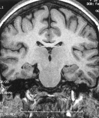 Spoiled gradient recall MRI showing right hippocam