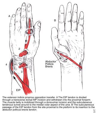 Opposition tendon transfer using the extensor indi