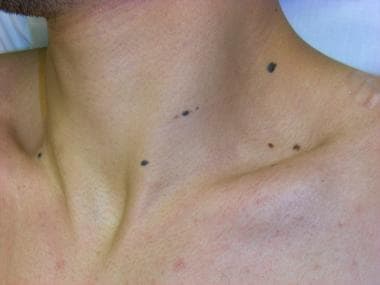 Benign pigmented lesion: Dermatosis papulosa nigra