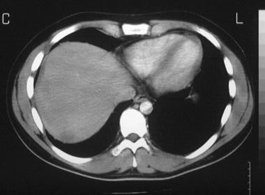 Grade 1 hepatic injury in a 21-year-old man with a