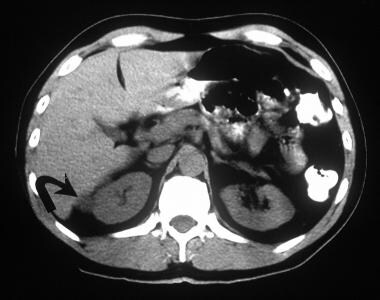 Kidney Angiomyolipoma Imaging: Overview, Radiography, Computed Tomography