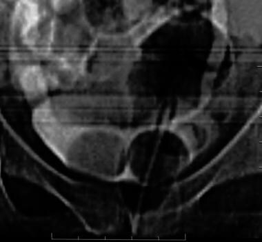Scout CT scan shows a right ureterocele within the