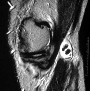 Sagittal, T2-weighted magnetic resonance image sho