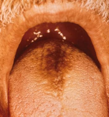 Hairy Tongue Cure 106