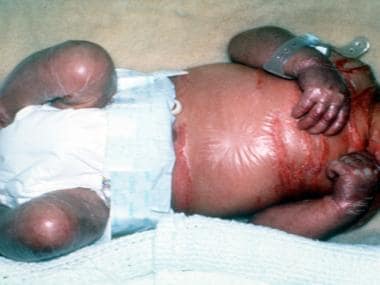 Collodion baby with translucent membrane of the bo