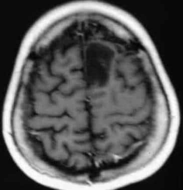 Preoperative MRI of the brain of a 28-year-old mal