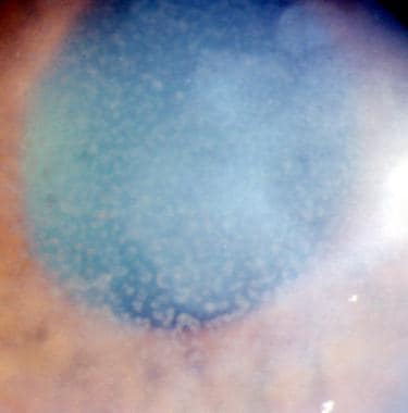 Pseudoguttata produced by uveal inflammation. Corn