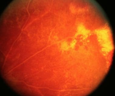 normal retina vs cmv retinitis