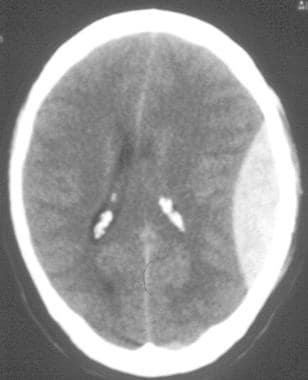CT scan of an acute left-sided epidural hematoma. 