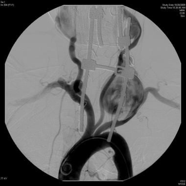 True vertebral artery aneurysm (9 cm). 