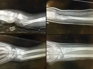 During a soccer game, a 12-year-old boy fractured
