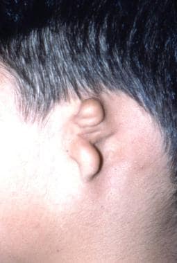 Grade 3 microtia: the most common type. 