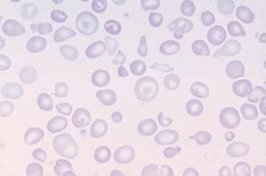 Peripheral blood film in Cooley anemia. 
