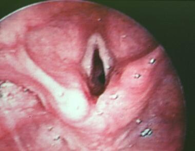 Intraoperative laryngeal view of the true vocal co
