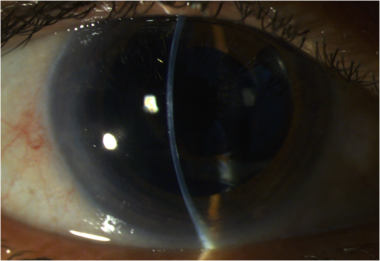 Slit lamp photograph of the same patient as above
