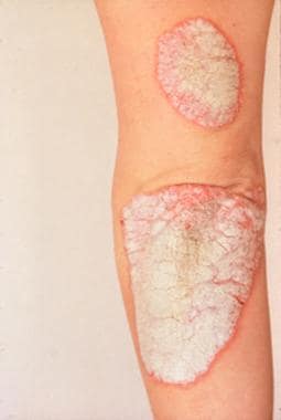 Psoriasis. 