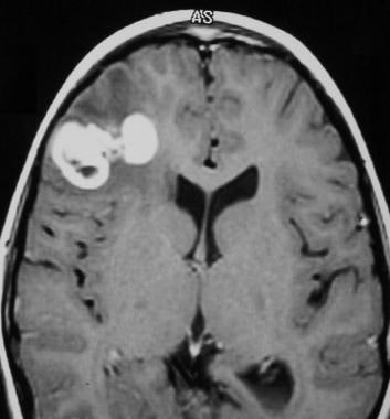 Case 5a. Anaplastic right frontal lobe parenchymal