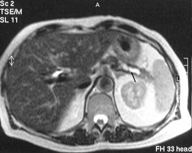 Chronic pancreatitis. Transaxial T2-weighted MRI s