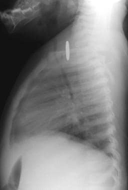 Lateral chest radiograph (obtained in the same pat