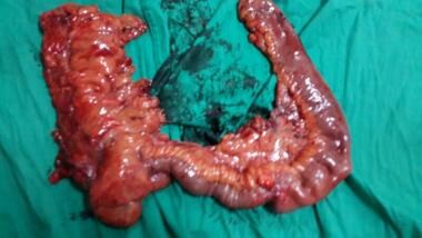 Open Right Colectomy (Right Hemicolectomy) Technique: Approach