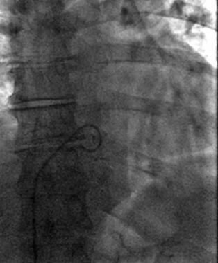 Right femoral vein approach with the St. Charles c