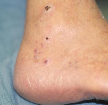 Classic Kaposi sarcoma on the foot of an elderly p