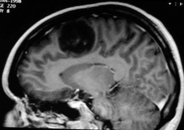 For tumors, MRI has the advantage of showing the l