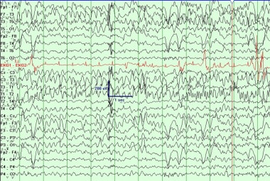 Left temporal lobe seizure. 