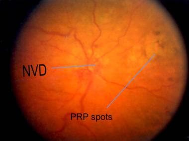 Fundus picture of the same patient with central re