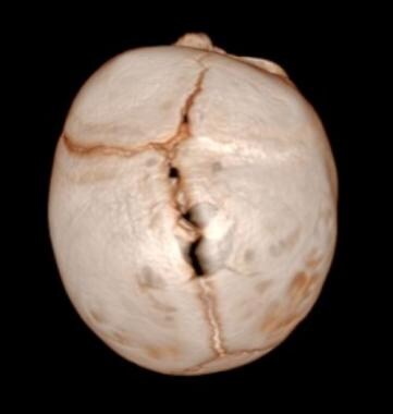 Preoperative top-down CT view of same patient with