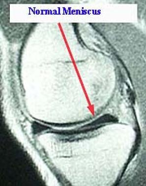 Magnetic resonance imaging scan showing a normal m