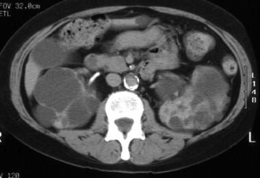 CT examination of the abdomen of a 70-year-old wom