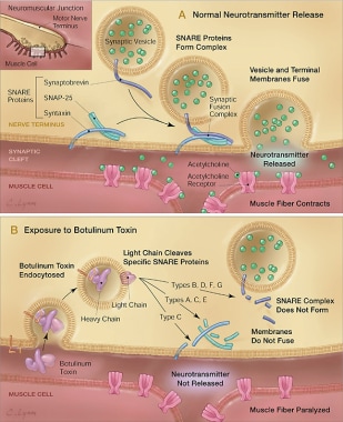 Courtesy of Arnon SS, et al. Botulinum toxin as a 