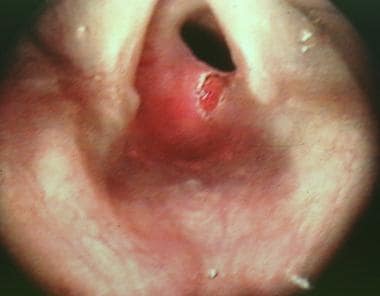 A close-up view of the stenosis in a 9-year-old bo