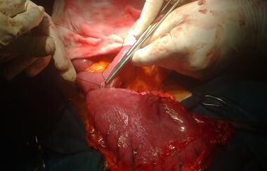 Subtotal gastrectomy. Following partially stapled