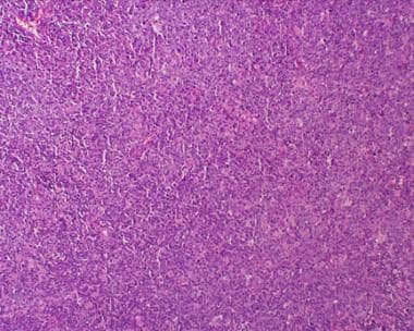 A patient with follicular lymphoma who was diagnos