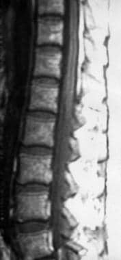 T1-weighted nonenhanced sagittal MRI of the lumbar