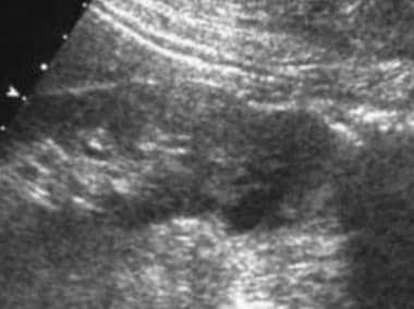 Case 21. Right renal cell carcinoma. Ultrasonogram