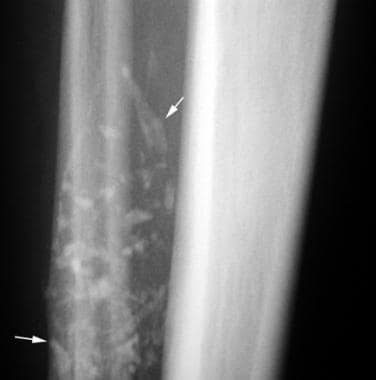 Magnified view of an anteroposterior radiograph of