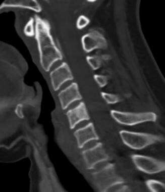 Sagittal CT image of the cervical spine demonstrat