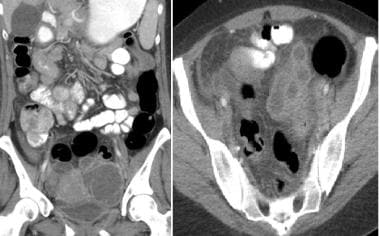 Forty-four-year-old woman underwent emergent CT fo