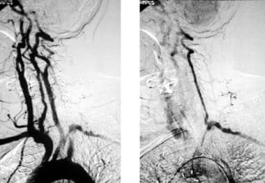 Arch aortogram initially shows apparent absence of