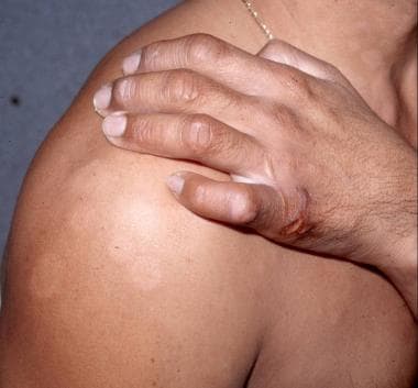 Multiple flat hypopigmented lesions on shoulder an