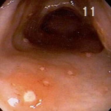 
Yersinia enterocolitis in a 45-year-old white wom