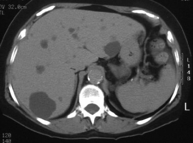 CT scan of the same patient (70-year-old woman wit