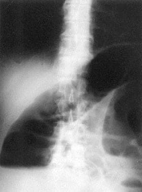 Large-Bowel Obstruction. Abdominal (kidney-ureter-