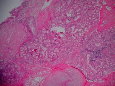 Chronic obstructive pulmonary disease (COPD). Hist