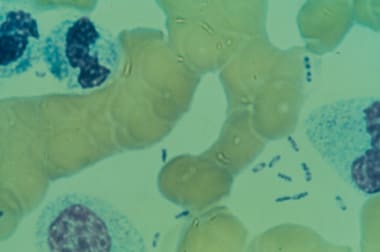 Wright stain peripheral blood smear of patient wit